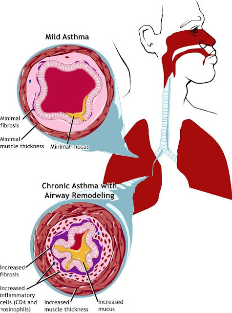 image252812529 Health news of the week: Asthma