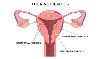 images-2021-08-17T212846.445 Causes of painful menstruation and Home treatments that helps relieve it.
